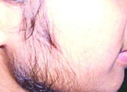 মেয়েদের মুখে যে কারণে দাড়ি ওঠে
