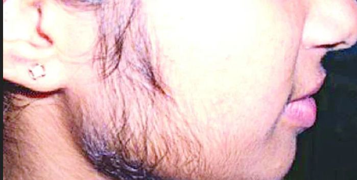 মেয়েদের মুখে যে কারণে দাড়ি ওঠে